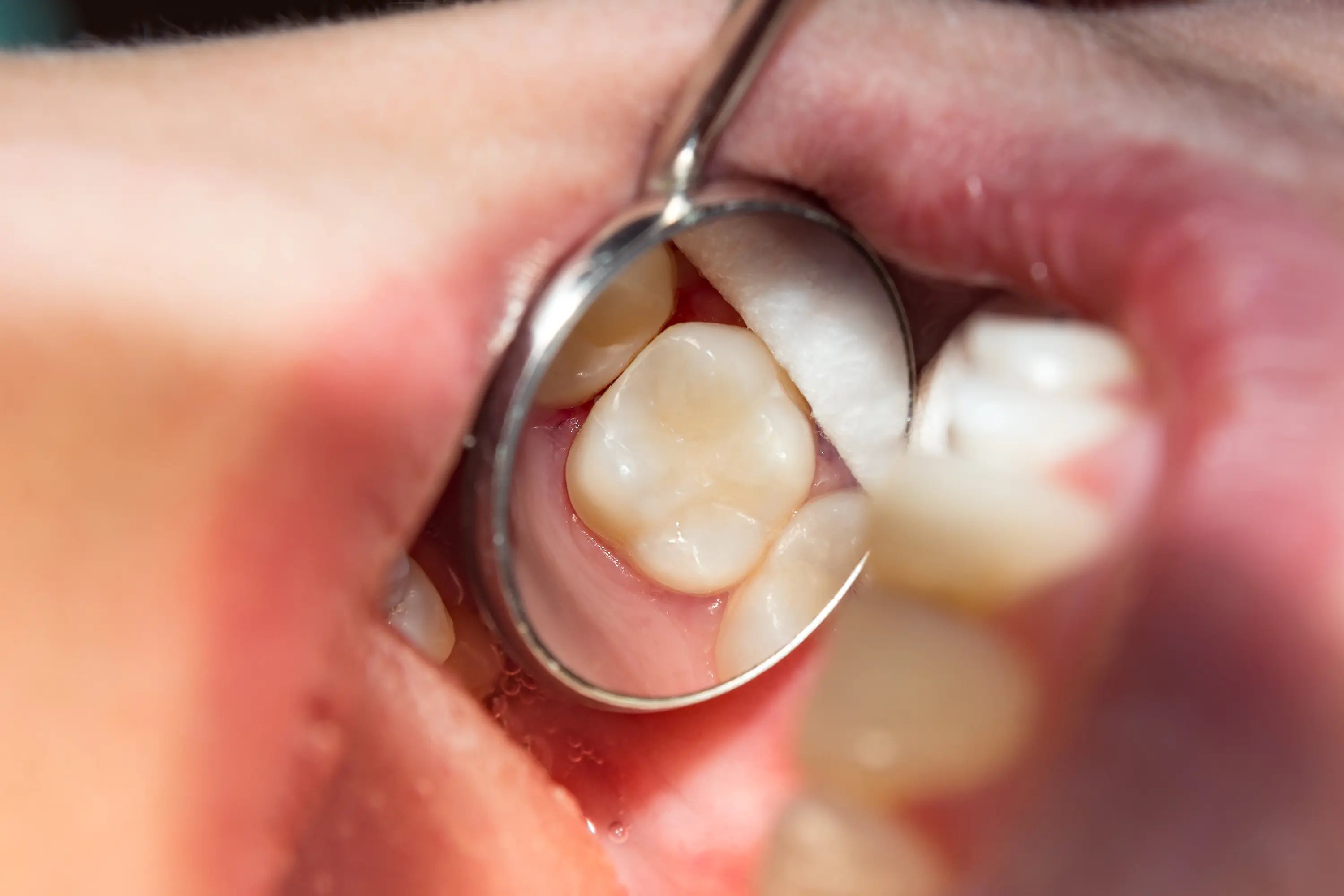 Minimally-Invasive Dental Fillings - Restorative Dentistry in Sacramento - Ideal Dentistry