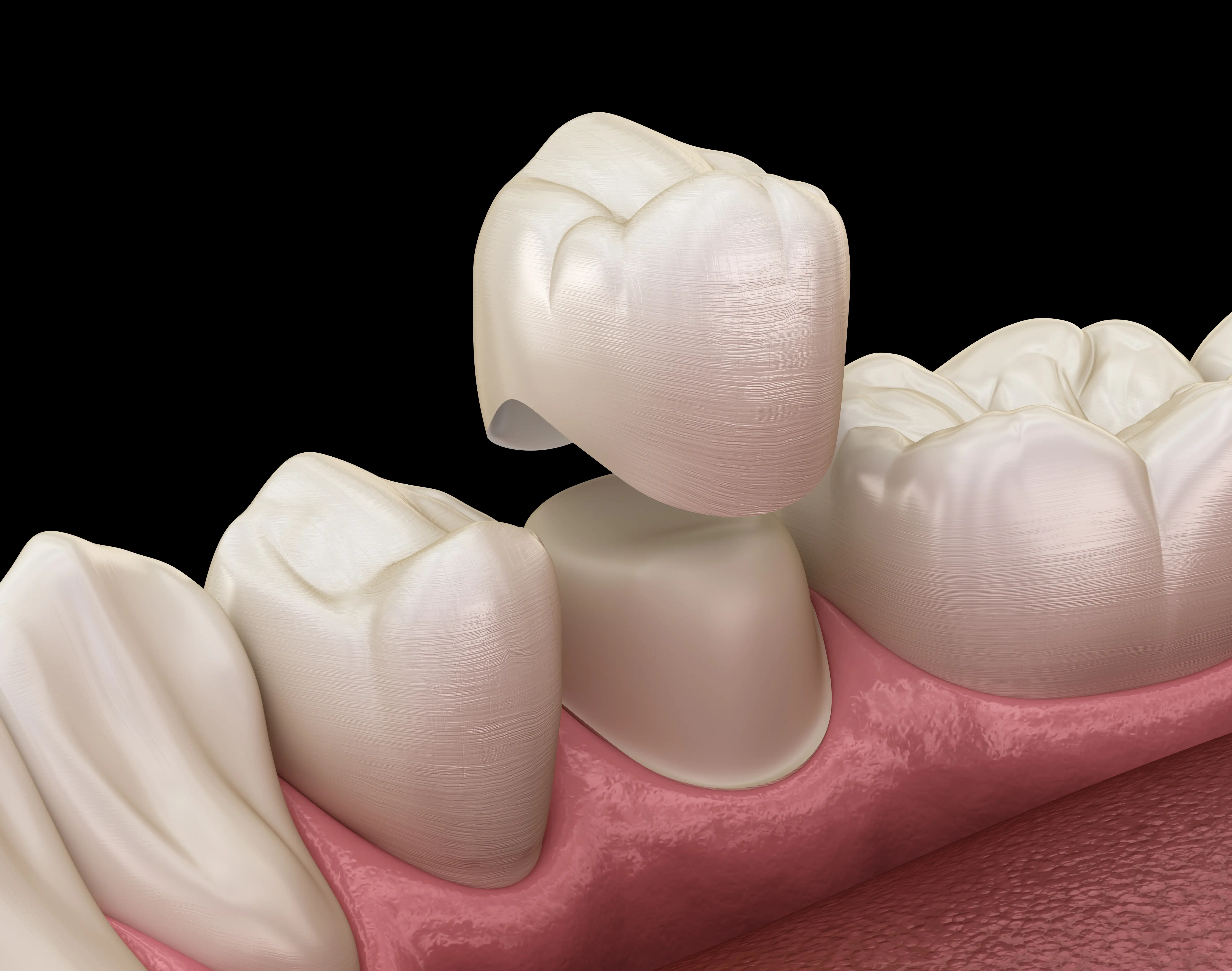 Full-Coverage Dental Crowns - Restorative Dentistry in Sacramento, CA - Ideal Dentistry