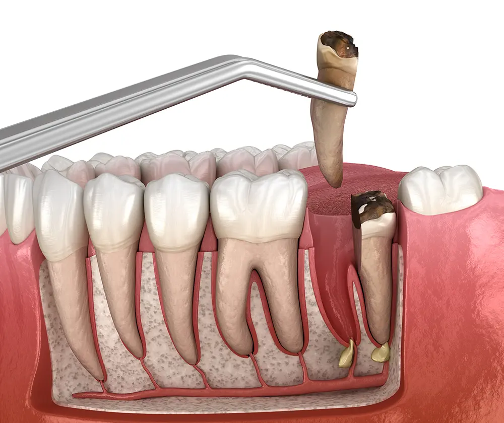Tooth Extraction in Sacramento - Ideal Dentistry